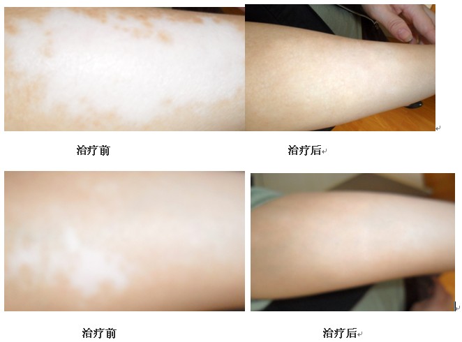 如何避免白癜风治疗的误区