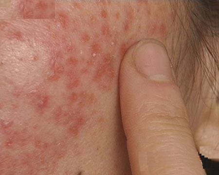 荨麻疹产生的根本原因主要是什么