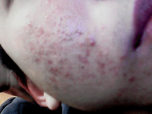 面部痤疮发病时的主要症状表现是什么