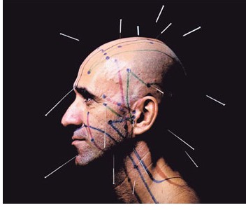 中医针灸治疗失眠