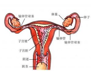 输卵管堵塞概述