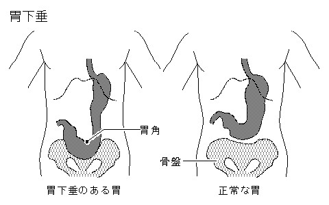 胃下垂应该如何有效预防