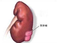 得了肾癌能活多久