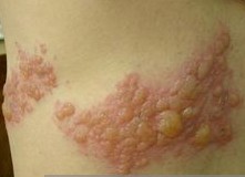 盘蛇疮的症状表现如何