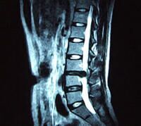 坐骨神经痛会出现什么症状?