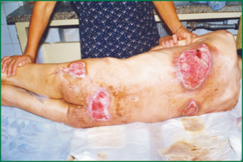 褥疮得了如何治疗