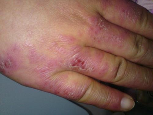 冬季长冻疮要如何护理