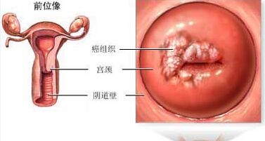 诱发宫颈癌的原因