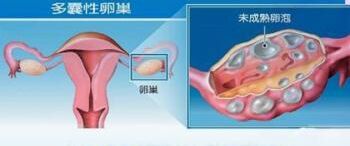 多囊卵巢患者在饮食上应该注意的问题