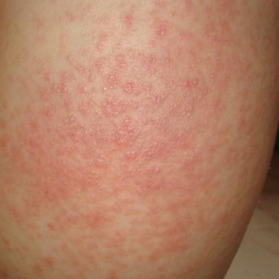 神经性皮炎的危害