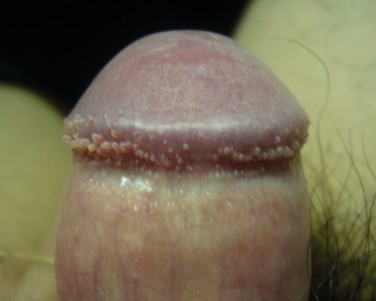 生殖器冠状沟长丘疹是怎么回事？