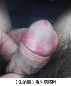 龟头溃疡是怎么回事？