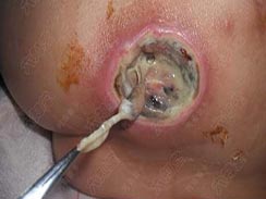 褥疮清创的建议