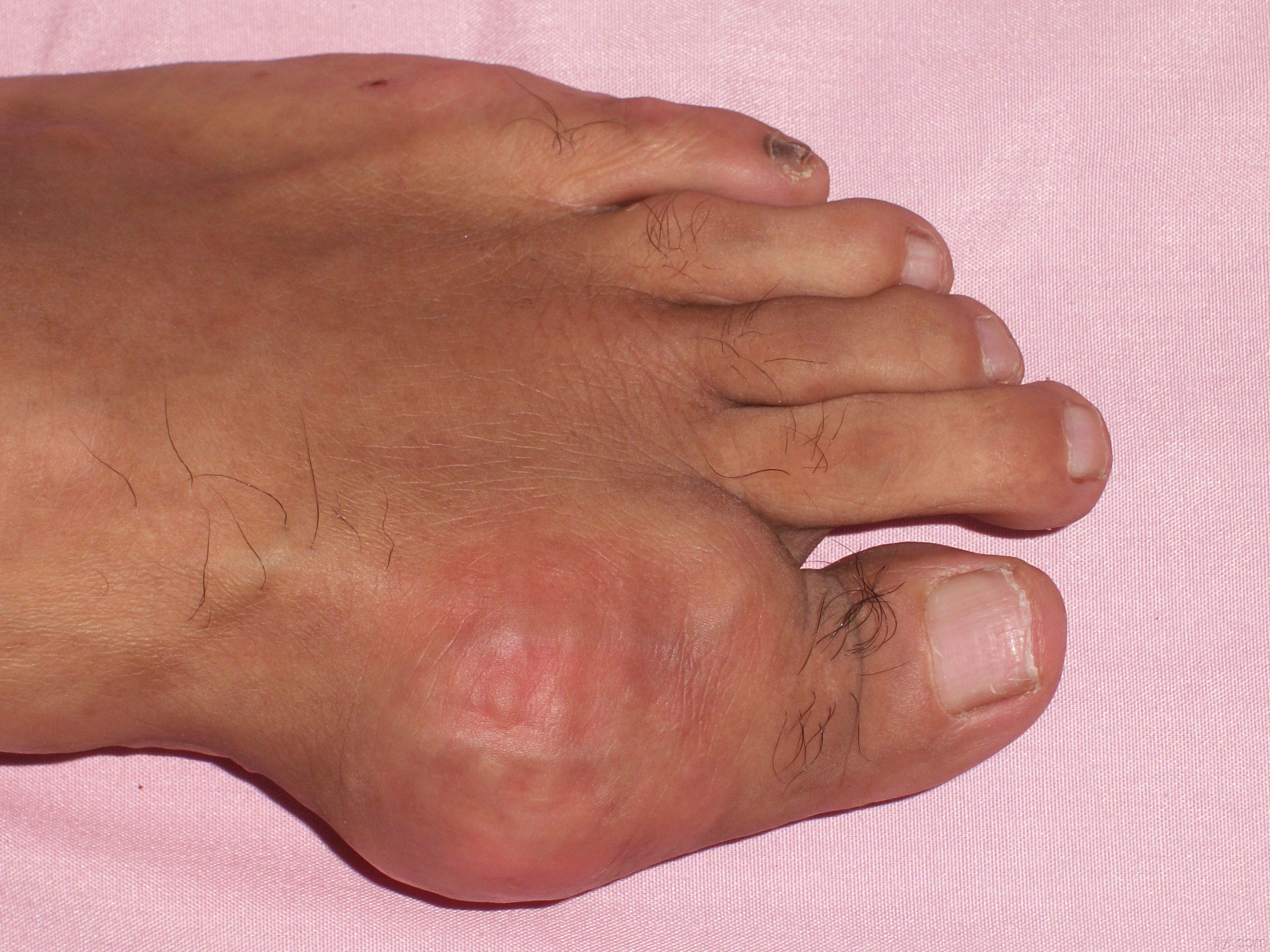 天颐堂让他远离痛风的困扰