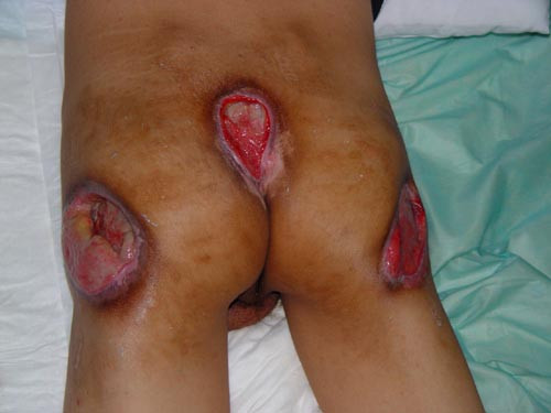 预防褥疮要“三看”