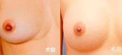 中医治疗乳腺增生，效果显著