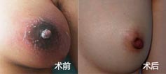 不幸患上乳腺结节，天颐堂中医还我健康